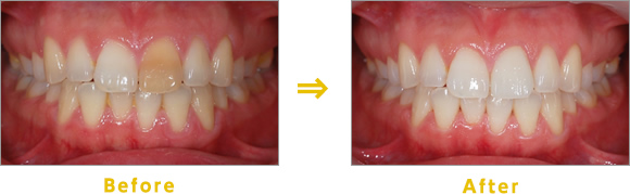 Before→After