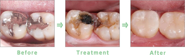 Before→Treatment→After