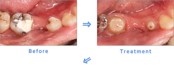 Before→Treatment→