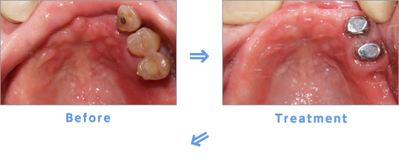 Before→Treatment→