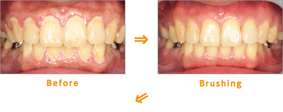 Before→Brushing→