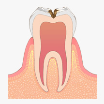 虫歯治療イメージ
