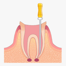 歯内治療イメージ