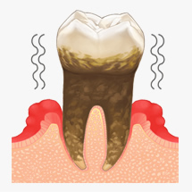 歯周病治療イメージ
