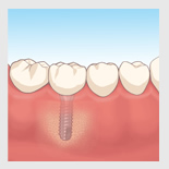 インプラント