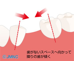 歯がないスペースへ向かって隣の歯が傾く