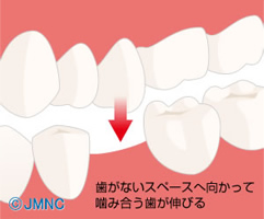 歯がないスペースへ向かって噛み合う歯が伸びる