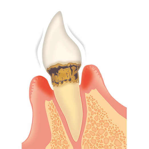 中度歯周病について