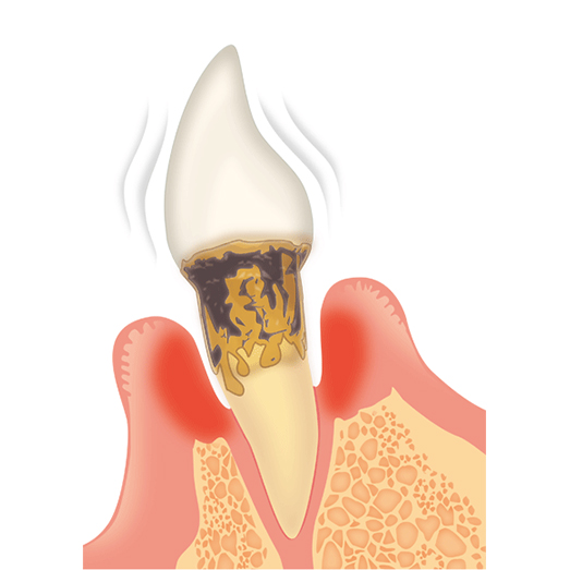 重度歯周病について