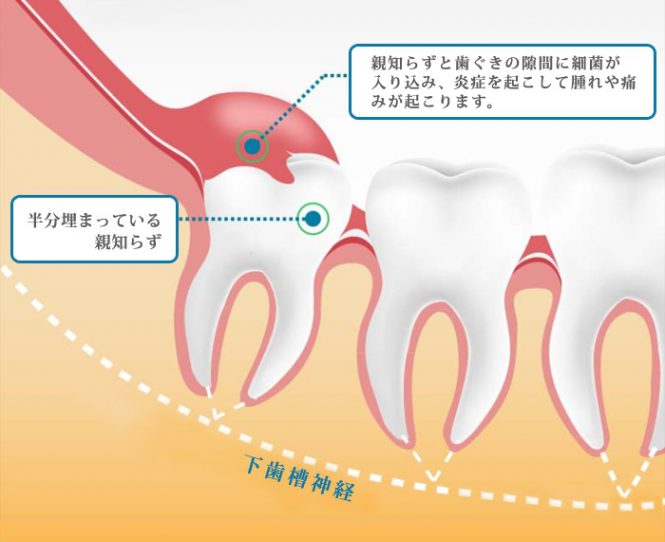 親知らずって? 枚方の歯医者【本多歯科】 親知らずって? 枚方の歯医者【本多歯科】