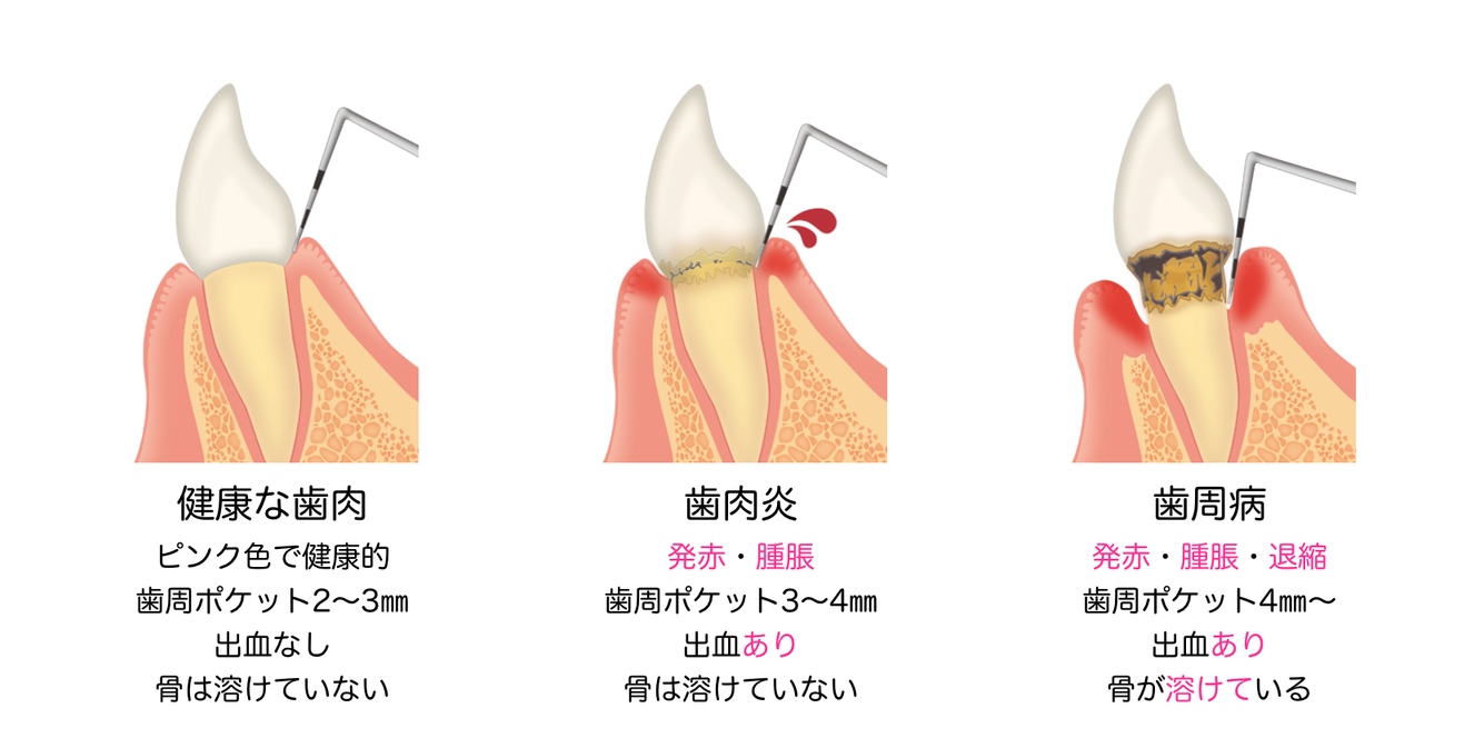 歯肉炎から歯周炎へ | 本多歯科ブログ | 枚方の歯医者【本多歯科】