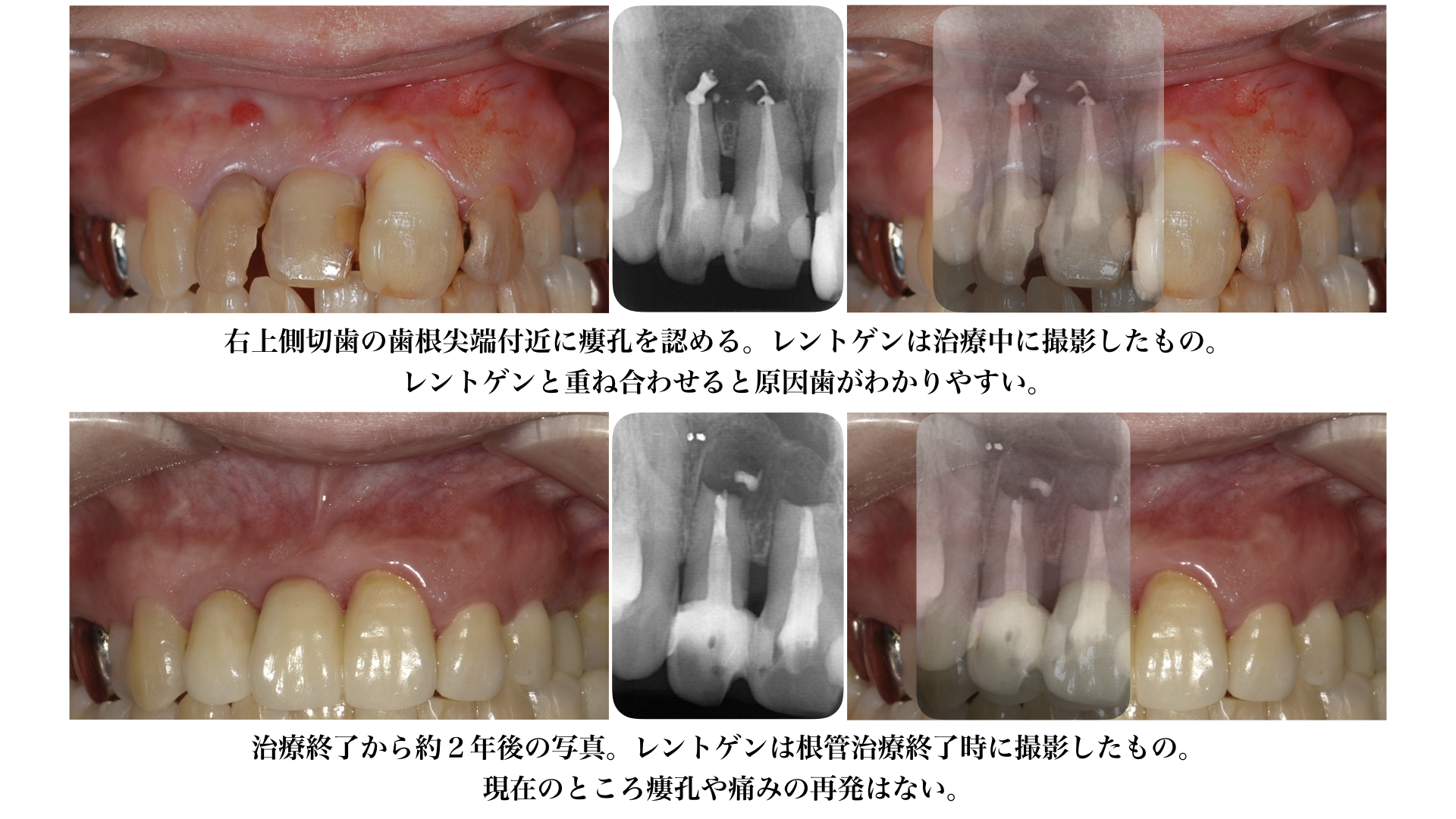 歯茎膿 繰り返す: 歯茎が腫れて痛い – PKLE