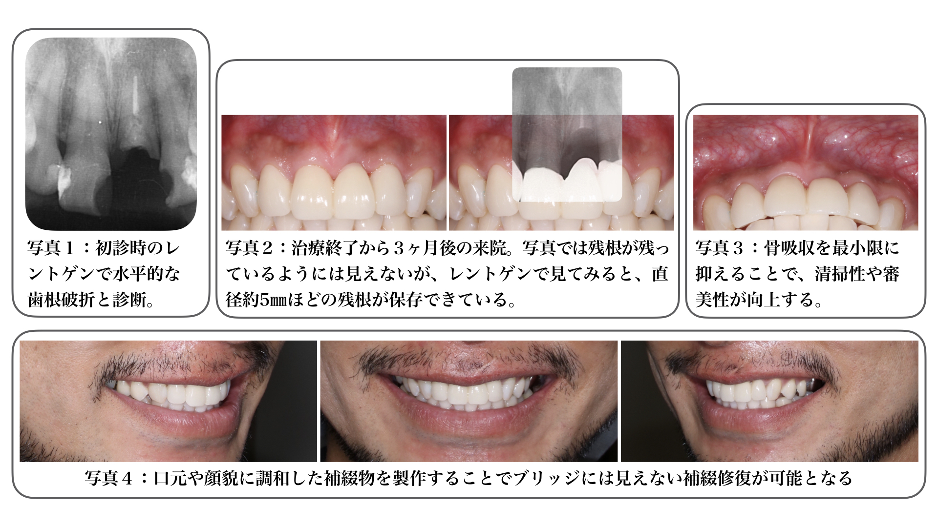 歯に膿がたまる原因 _ 歯茎の膿で顔が腫れたのですが、どうしたらよいですか – WIEJI